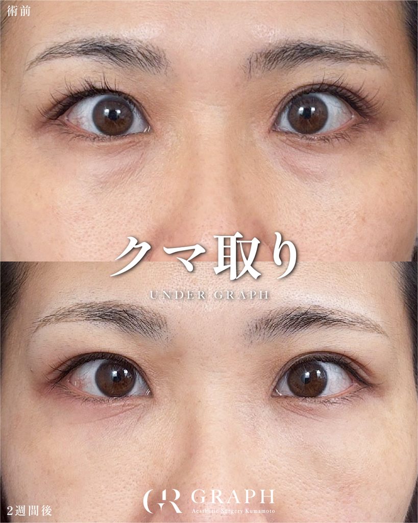 裏ハムラ症例