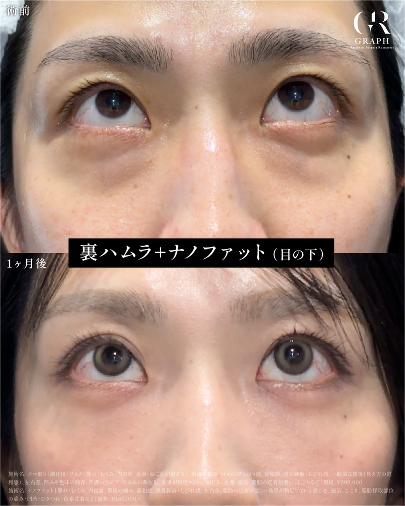 クマ取り【31歳|裏ハムラ+ナノファット】