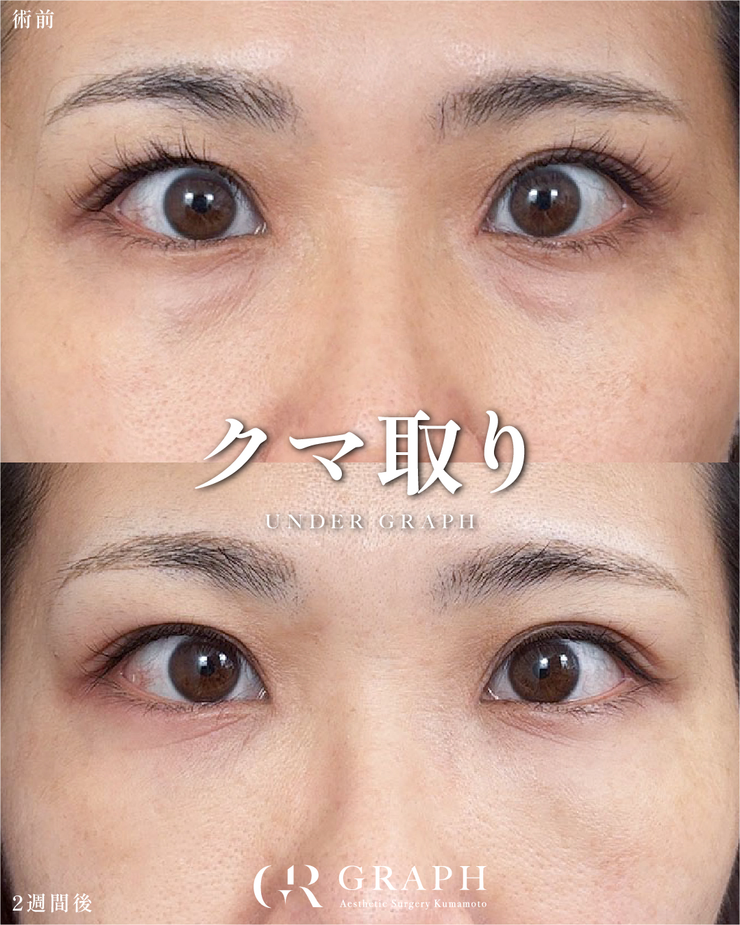 クマ取り【32歳｜裏ハムラ】
