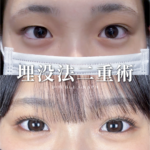 埋没法二重術【18歳｜女性｜平行型】