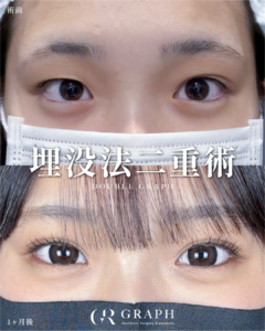 埋没法二重術【18歳｜女性｜平行型】