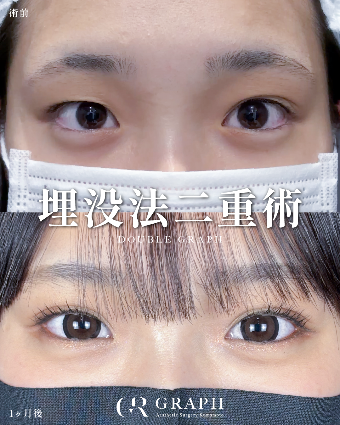 埋没法二重術【18歳｜女性｜平行型】