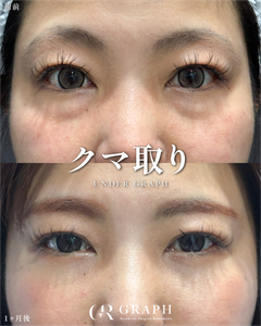 クマ取り【34歳｜裏ハムラ】