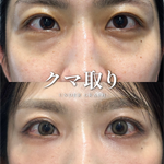 クマ取り【31歳｜裏ハムラ+ナノファット】