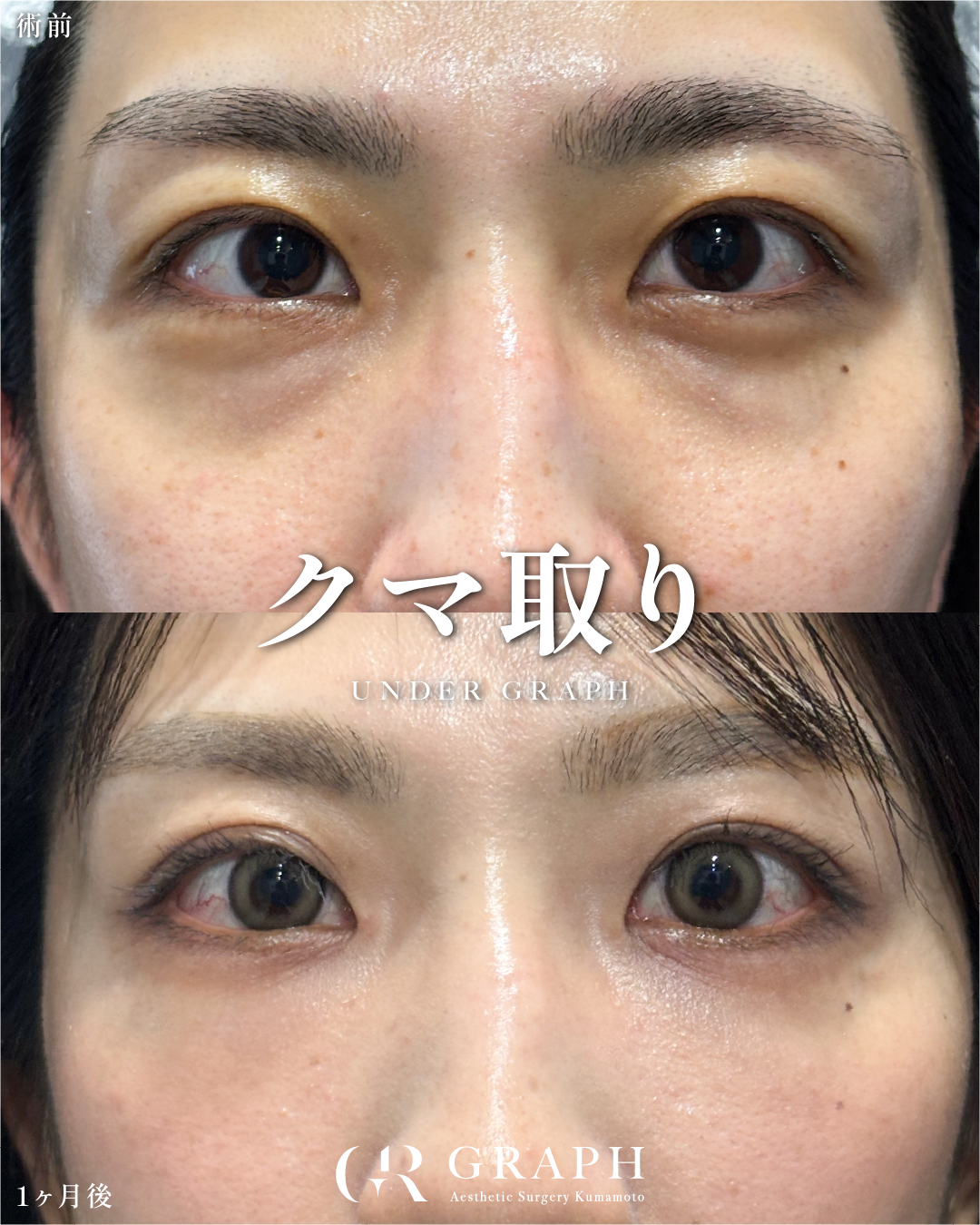 クマ取り【31歳｜裏ハムラ+ナノファット】